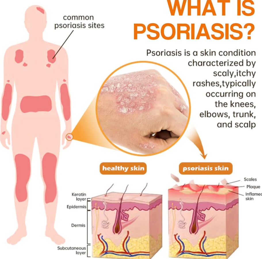 LAST DAY OF DISCOUNT 🔥 BeeVenom Psoriasis Care Spray Pro