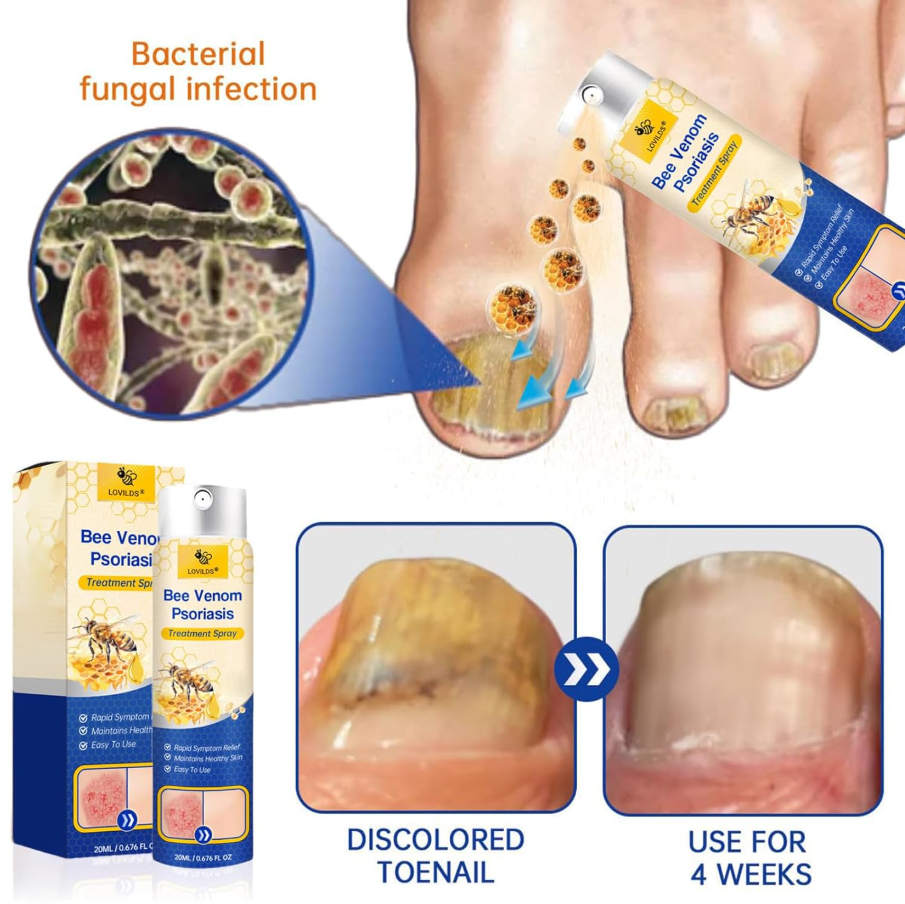 LAST DAY OF DISCOUNT 🔥 BeeVenom Psoriasis Care Spray Pro