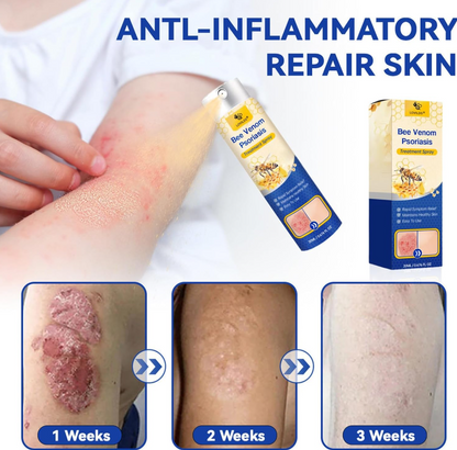 LAST DAY OF DISCOUNT 🔥 BeeVenom Psoriasis Care Spray Pro